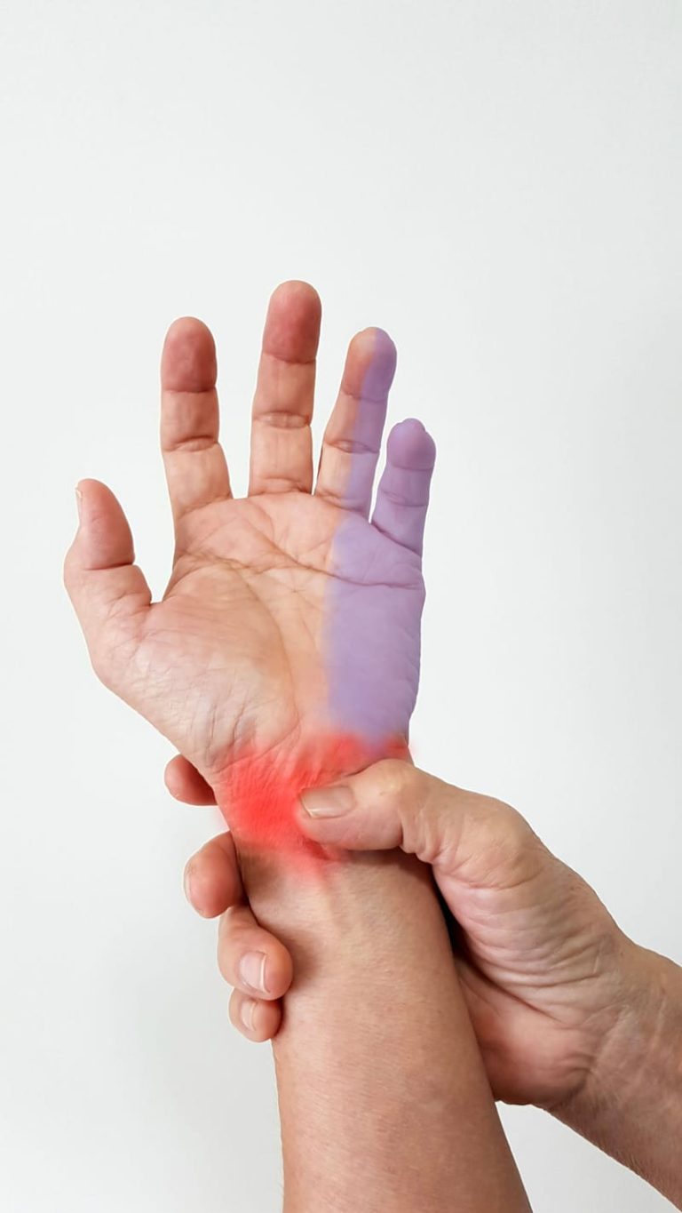 תסמונת התעלה הקוביטלית (Cubital Tunnel Syndrome)