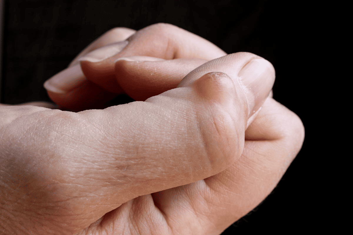 Ganglion Cyst Removal Tacoma | Dr. Dehghan | Artistic Plastic