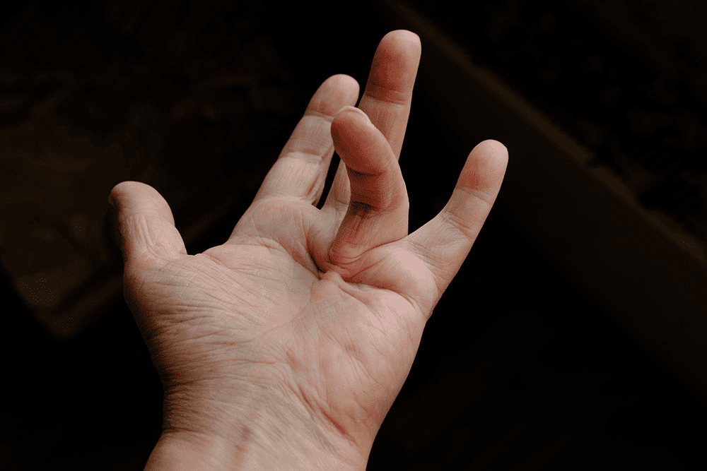 Dupuytren contracture