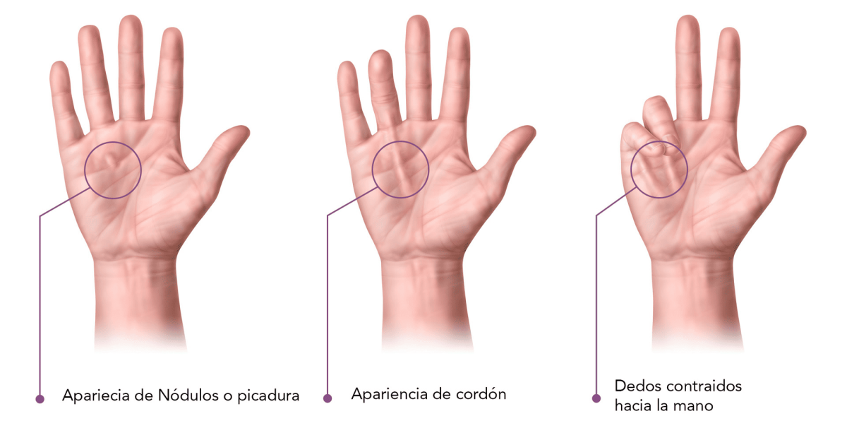 Dupuytren's disease - Corporis Fisioterapia - Marbella